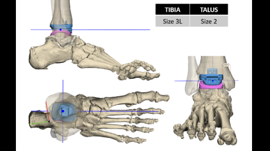 restore 3d implants noted in blue. (restore3d image)