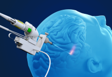 Monteris and Symphony partner on laser ablation platform Monteris and Symphony partner on laser ablation platform