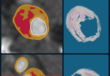 Elucid launches AI software for arterial plaque measurement Elucid launches AI software for arterial plaque measurement