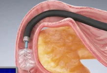 Aqua Medical wins FDA IDE to launch trial for ablation procedure that treats diabetes Aqua Medical wins FDA IDE to launch trial for ablation procedure that treats diabetes