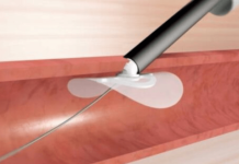 Haemonetics acquires Irish vessel closure company Vivasure for $116.4M Haemonetics acquires Irish vessel closure company Vivasure for $116.4M