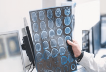 Epiminder conducts first US implant of Minder epilepsy monitoring system Epiminder conducts first US implant of Minder epilepsy monitoring system