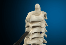 SurGenTec secures FDA clearance for ION-C Facet Fixation System SurGenTec secures FDA clearance for ION-C Facet Fixation System