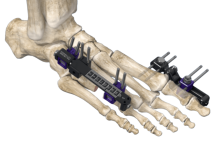 Zimmer Biomet launches new foot and ankle system Zimmer Biomet launches new foot and ankle system