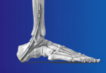 Zimmer Biomet, Paragon 28 announce commercial launch of curved TTC nail system Zimmer Biomet, Paragon 28 announce commercial launch of curved TTC nail system