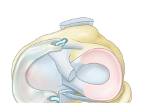 ATRO Medical secures €3M to advance artificial meniscus toward pivotal studies ATRO Medical secures €3M to advance artificial meniscus toward pivotal studies