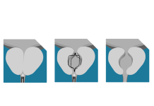 Prodeon gets FDA clearance for BPH-treating nitinol implant Prodeon gets FDA clearance for BPH-treating nitinol implant