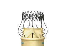 Corcym reports first U.S. implantation of next-gen sutureless aortic valve Corcym reports first U.S. implantation of next-gen sutureless aortic valve