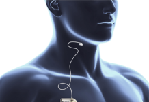 LivaNova reports positive findings for sleep apnea neuromod LivaNova reports positive findings for sleep apnea neuromod