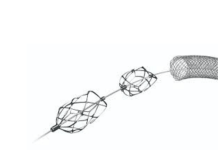 Endologix acquires Pounce thrombectomy system from Surmodics Endologix acquires Pounce thrombectomy system from Surmodics