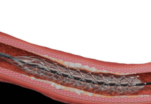 Reflow Medical has positive data for coronary drug-eluting stent Reflow Medical has positive data for coronary drug-eluting stent