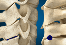 SurGenTec gets FDA nod for lumbar facet fixation system SurGenTec gets FDA nod for lumbar facet fixation system