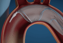 AorticLab earns expanded CE mark for embolic protection device AorticLab earns expanded CE mark for embolic protection device