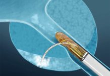 Francis Medical announces publication of VAPOR 2 pivotal trial results Francis Medical announces publication of VAPOR 2 pivotal trial results